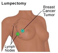 Lumpectomy