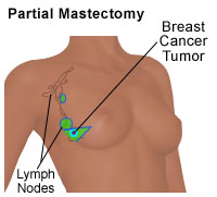 Partial Mastectomy