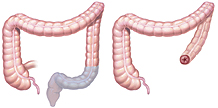 abdominal erineal resection