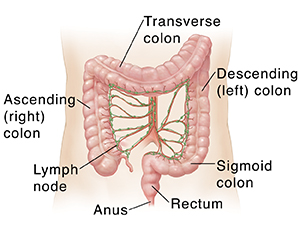 colorectal cancer