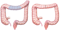 segmental resection