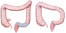 sigmoid hemicolectomy